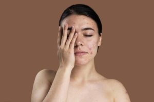 Acne caused by hormonal disorder